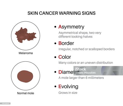 viso brutto uomo|Segnali di pericolo e immagini del melanoma .